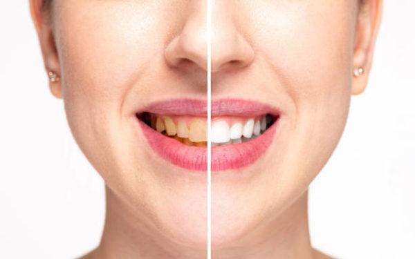 Los mayores mitos sobre la salud dental dientes blancos 