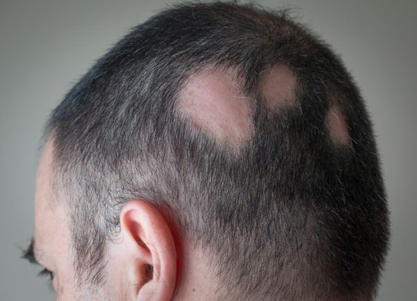 Que es la alopecia areata sintomas causas y tratamientos 